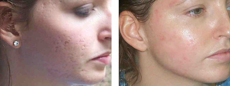acne-scar-r-face