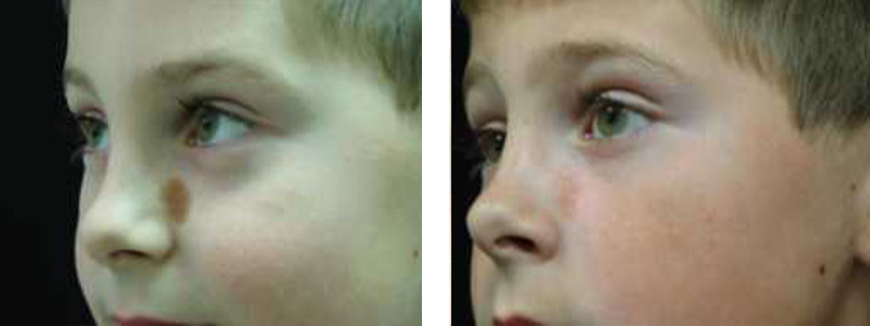 birthmark-nose-copy