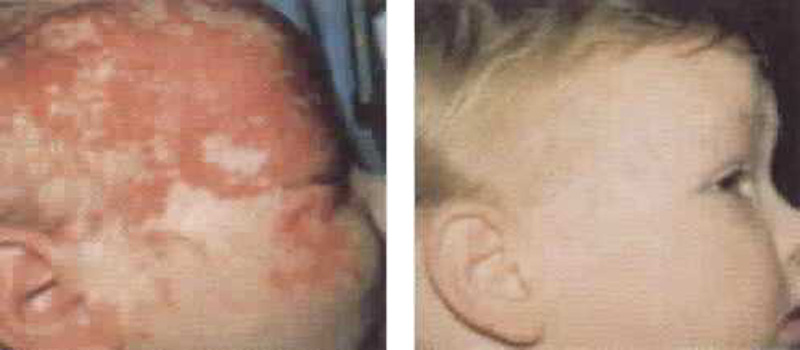 birthmark-pws-face-copy